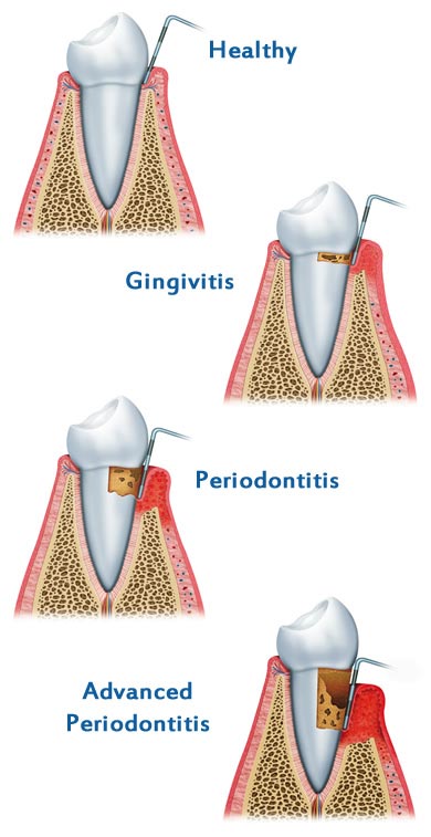 Gum disease treatment in Dearborn MI