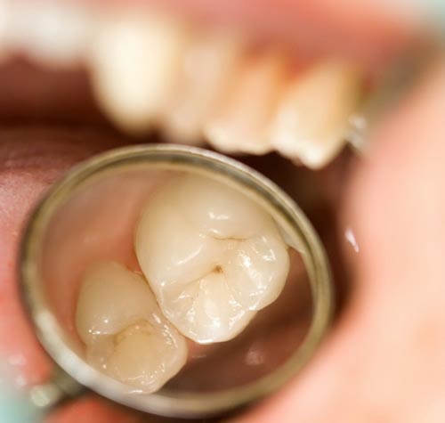 Gum disease treatment in Dearborn MI